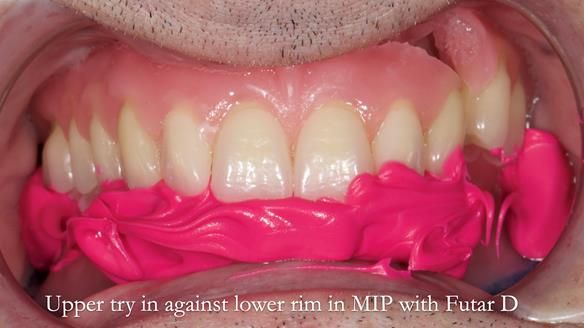 Newsletter 80 - Gordon’s dentures: the one case in 1,000 where my technique failed