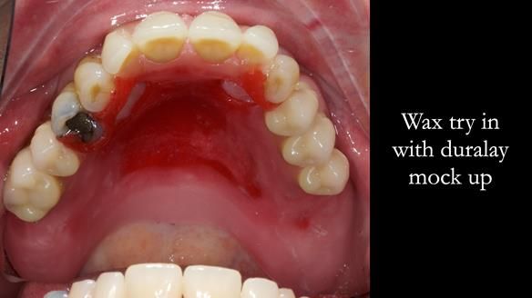 Finlay's Newsletter 59 Ultra hard partial dentures made for Gill