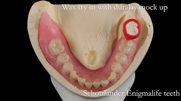 Finlay's Newsletter 59 Ultra hard partial dentures made for Gill