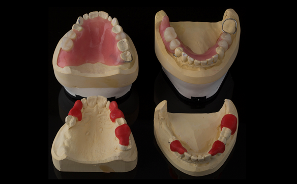 Figure 27 Finished immediate dentures and preparation guides for sectioning the bridges to create guide surfaces allowing accurately fitting immediate dentures