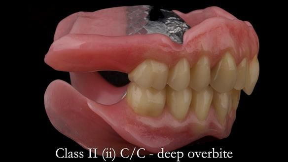 Complete denture Class II div 2 deep overbite Newsletter 39
