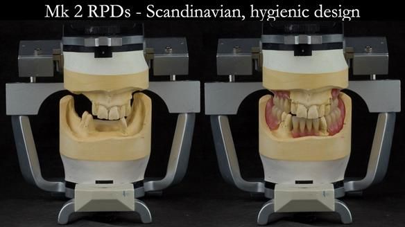 Finlay's Case Study Newsletter 40 - Immediate Mk 1 RPD to Definitive Mk 2 RPD - full protocol