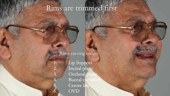Finlay's Newsletter 62 provision of extractions and metal based complete dentures for Rafique