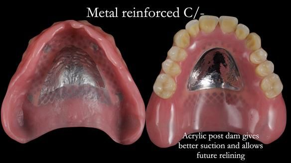 Newsletter 54 case presentation upper complete denture and lower Scandinavian designed hygienic partial denture for David