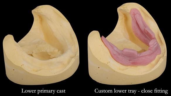 Complete denture Class II div 2 deep overbite Newsletter 39