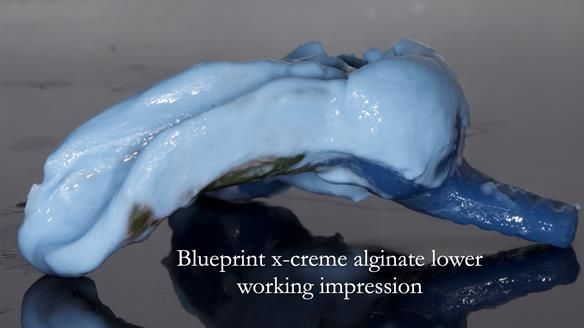 Newsletter 55 Provision of metal based partial dentures for Zephyrine with a repaired cleft lip and palate