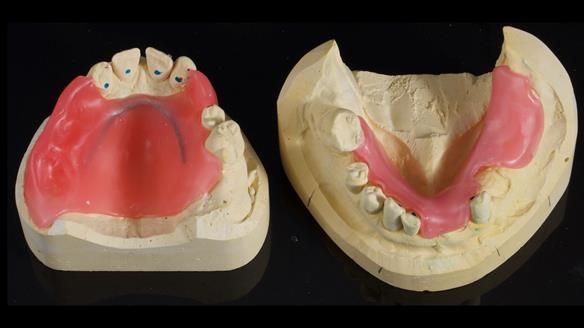 Newsletter 86 Peter the Architect — precision removable partial dentures case study