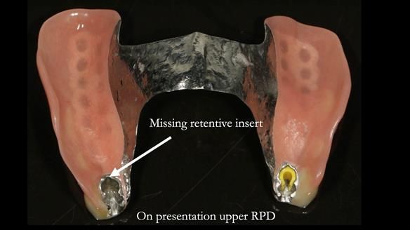 Newsletter 76: Jackie’s case – Telescopic overdenture & precision RPD (the tricky truth!)
