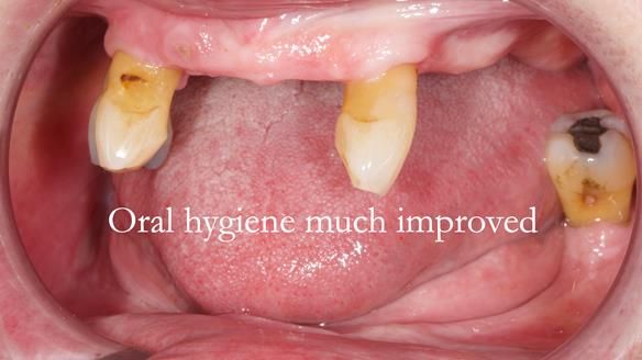 Finlay's Newsletter 59 Ultra hard partial dentures made for Gill