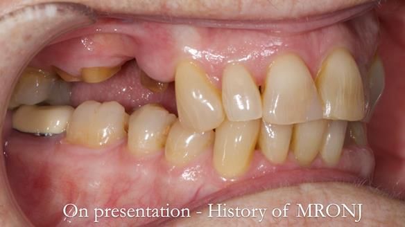 Finlay's Newsletter 60 Sylvia's upper Kennedy Class 2 Mod 1 metal based upper RPD