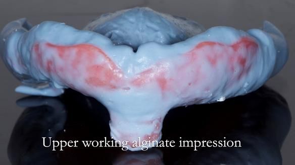 Complete denture Class II div 2 deep overbite Newsletter 39