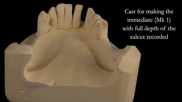 Finlay's Case Study Newsletter 40 - Immediate Mk 1 RPD to Definitive Mk 2 RPD - full protocol