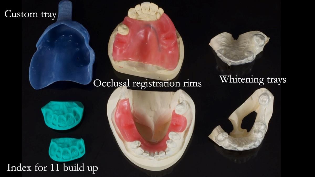 Newsletter 89 – Simon: A Challenging Kennedy Class II Division 1 Upper CoCr Partial Denture with a High Smile Line
