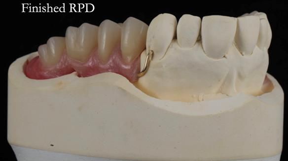 Finlay's Newsletter 60 Sylvia's upper Kennedy Class 2 Mod 1 metal based upper RPD
