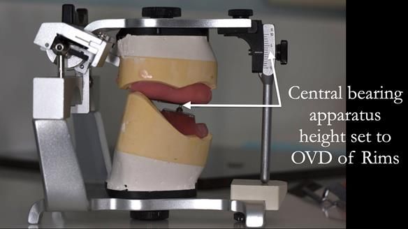 Newsletter 75: Marion’s case - Step-by-step complete denture workflow