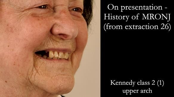 Finlay's Newsletter 60 Sylvia's upper Kennedy Class 2 Mod 1 metal based upper RPD