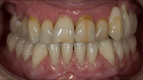 Figure 32 Finished denture mimicking the natural teeth. Schottlander Enigmalife denture teeth and Dental D clasps