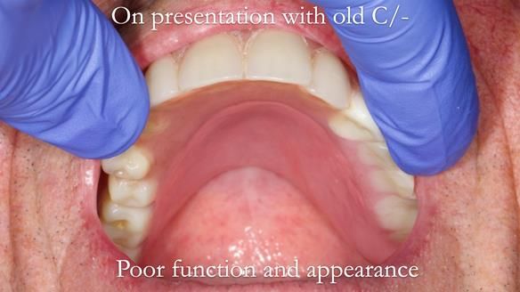 Newsletter 54 case presentation upper complete denture and lower Scandinavian designed hygienic partial denture for David