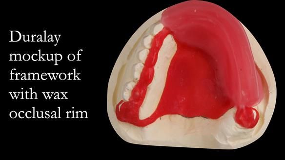 Upper metal base partial denture/occlusal stabilisation splint/obturator - full protocol