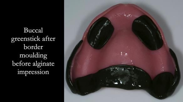 Newsletter 75: Marion’s case - Step-by-step complete denture workflow