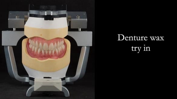 Newsletter 75: Marion’s case - Step-by-step complete denture workflow