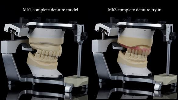 Newsletter 77: Jeremy’s case – immediate complete upper denture