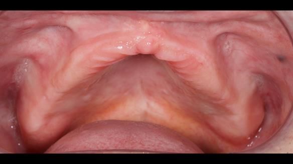 Newsletter 80 - Gordon’s dentures: the one case in 1,000 where my technique failed