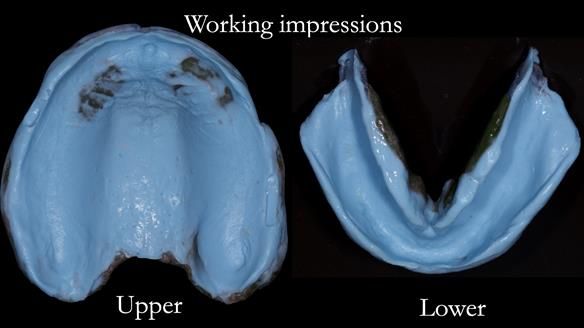 Newsletter 53 showing the making and fitting of ultra life-like dentures for Valena