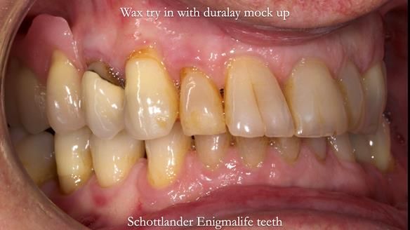 Finlay's Newsletter 64 case study - provision of a Kennedy class 2 metal based Scandinavian RPD for Ian