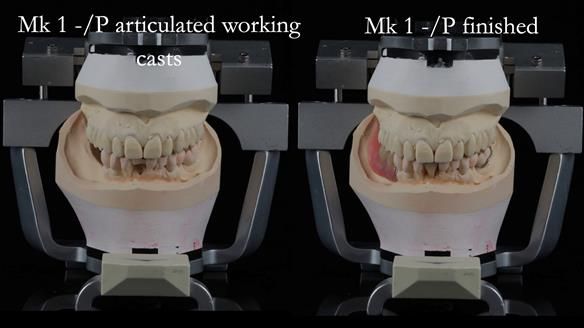 Newsletter 54 case presentation upper complete denture and lower Scandinavian designed hygienic partial denture for David