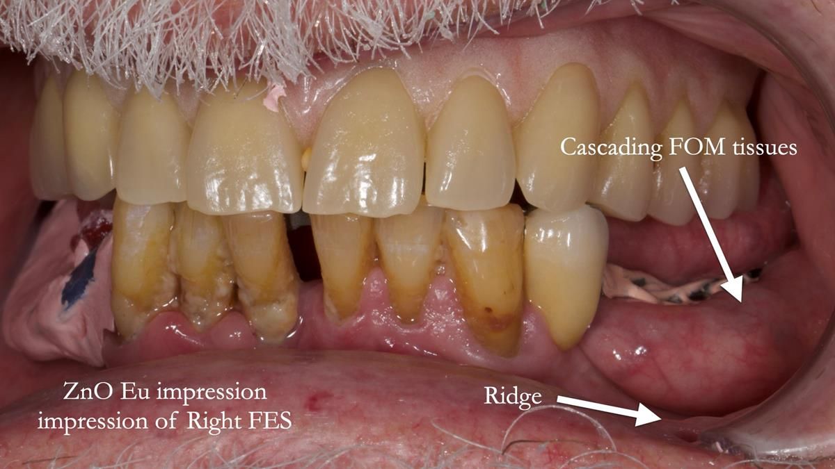 Newsletter 87 – Father Peter: A Partial Denture that needed Minor Miracle