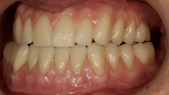 Finished dentures - mimicking Mary’s daughters natural teeth