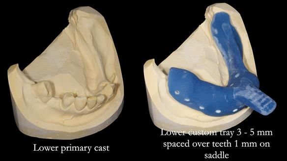 Newsletter 55 Provision of metal based partial dentures for Zephyrine with a repaired cleft lip and palate