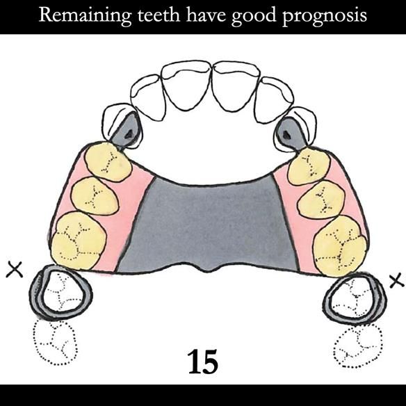 Universal Scandinavian partial denture designs