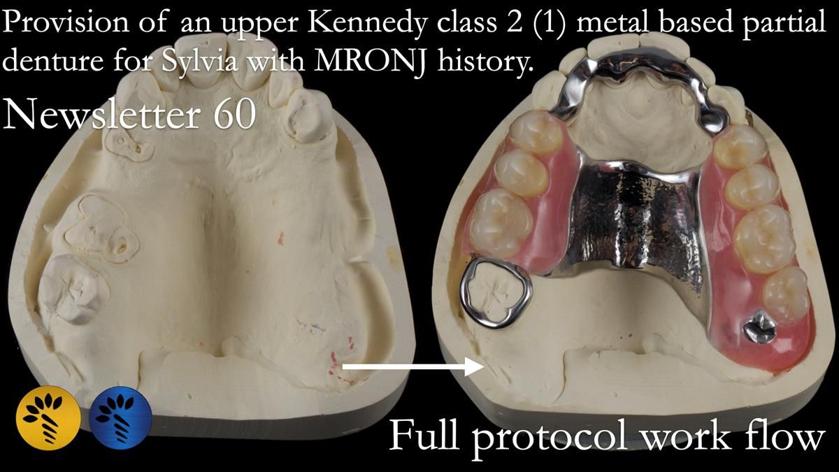 Finlay's Newsletter 60 Sylvia's upper Kennedy Class 2 Mod 1 metal based upper RPD
