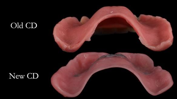 Finlay's Newsletter 62 provision of extractions and metal based complete dentures for Rafique