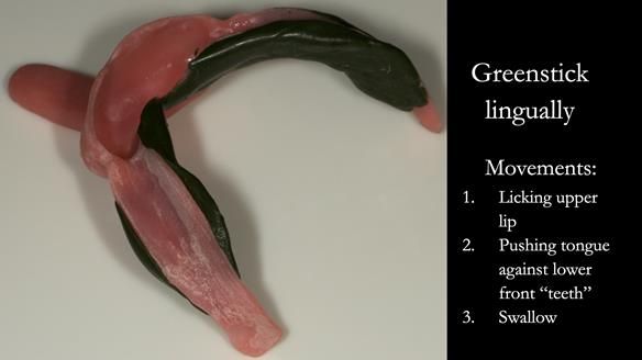 Greenstick right - right and left lingually from second molar to second molar – avoiding the retromolar pad - this is moulded in the patients mouth by the patient licking the upper lip from right to left commissures, pushing the tongue against the lower