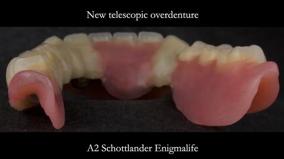 Newsletter 76: Jackie’s case – Telescopic overdenture & precision RPD (the tricky truth!)