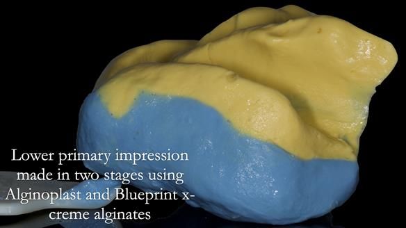 Newsletter 53 showing the making and fitting of ultra life-like dentures for Valena