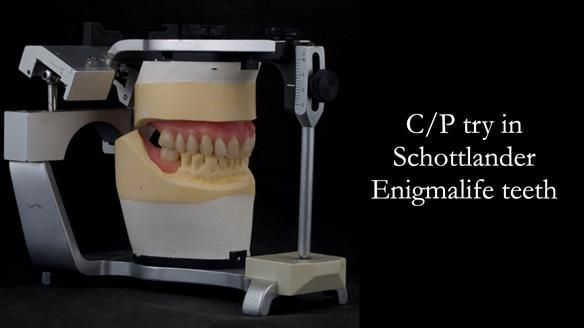 Solving Linda’s Failed “All on 4” implant bridges - full protocol Newsletter 42