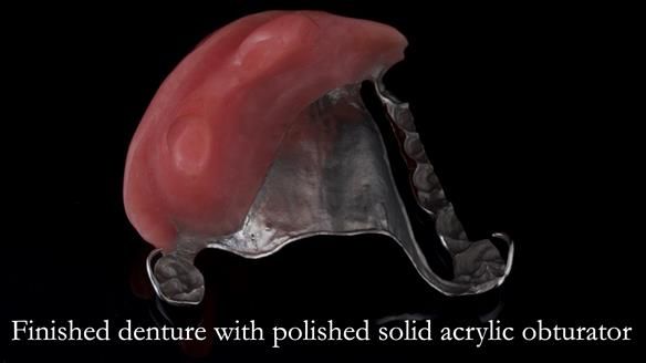 Upper metal base partial denture/occlusal stabilisation splint/obturator - full protocol
