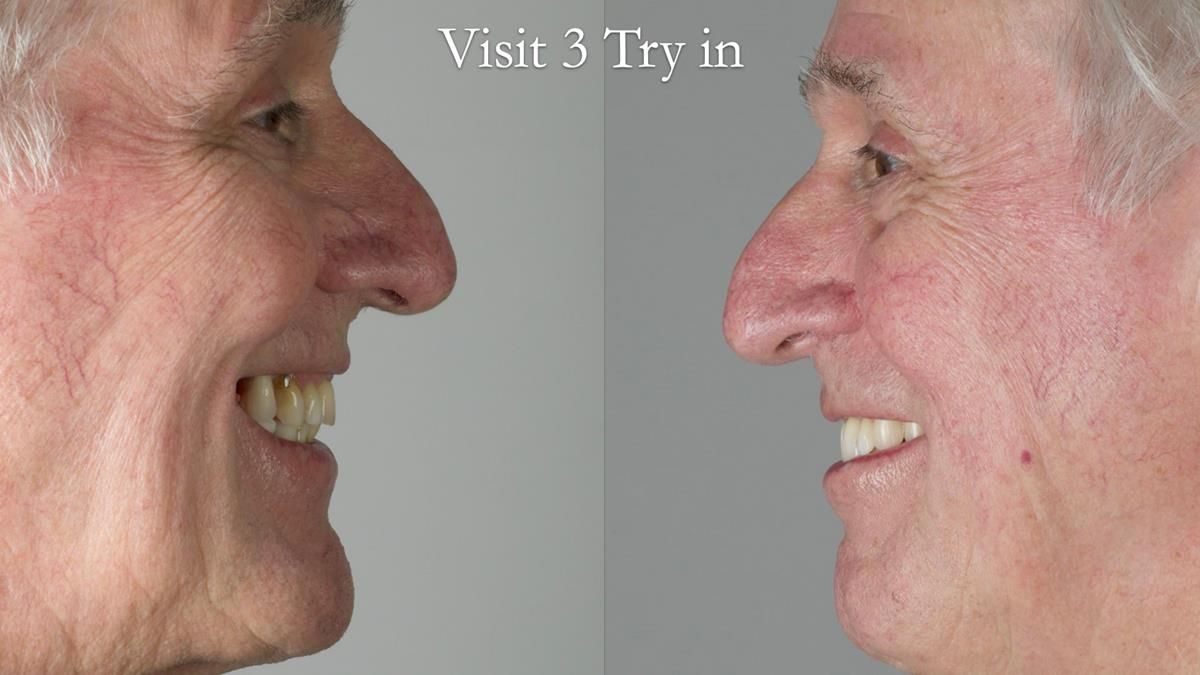 Newsletter 89 – Simon: A Challenging Kennedy Class II Division 1 Upper CoCr Partial Denture with a High Smile Line