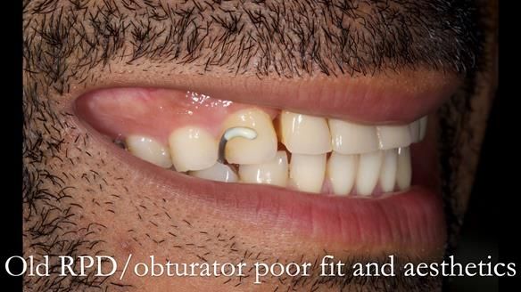 Acrylic based partial denture/obturator had poor, retention and support Obturator section was in poor condition. The Adams clasp were causing inflammation of the gingival margins. The clasp on the UR3 was visible resulting in poor appearance. Reduced lip 