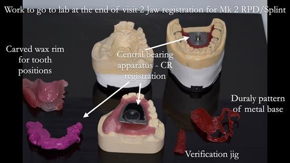 Newsletter 51 Managing Anne’s failing dentition with distal extension base RPD/Splint FULL PROTOCOL