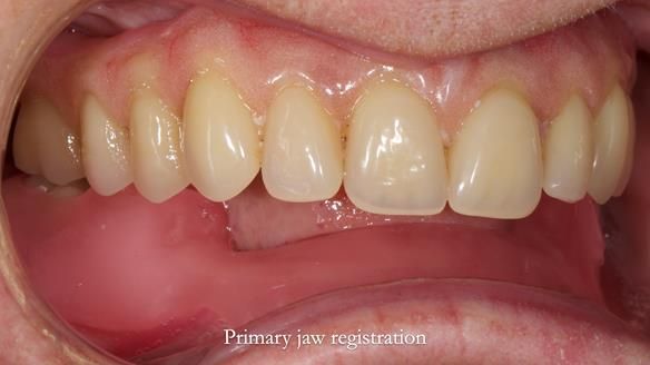 Newsletter 82 Mary - A complete upper and a one-tooth gasket denture