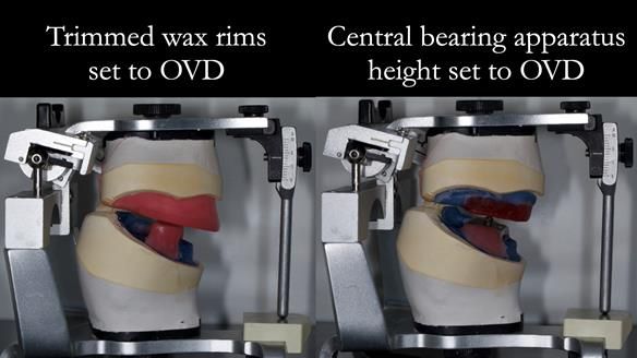 Newsletter 80 - Gordon’s dentures: the one case in 1,000 where my technique failed