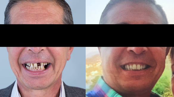 Figure 22 This pre-treatment photo on the right was used as the basis for the Mk 1 immediate denture