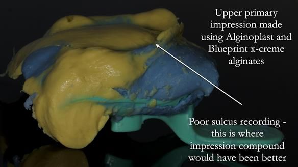 Newsletter 83: Sheila’s Complete Denture Success