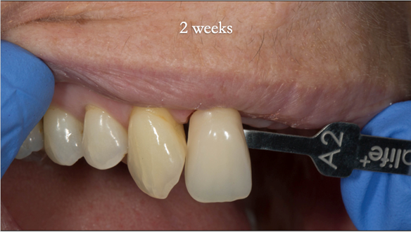 Figure 53 One shade lighter after two weeks of 10% Carbamide peroxide - nighttime whitening