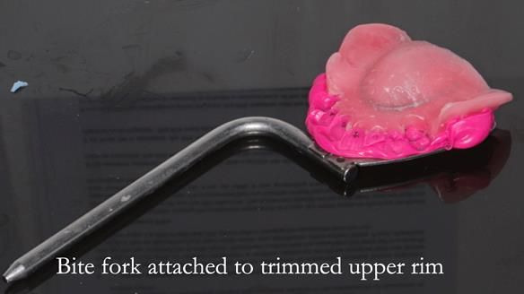 Newsletter 56 showing the making and fitting of a bilateral free end saddle upper removable partial denture (RPD) for patient with pemphigus